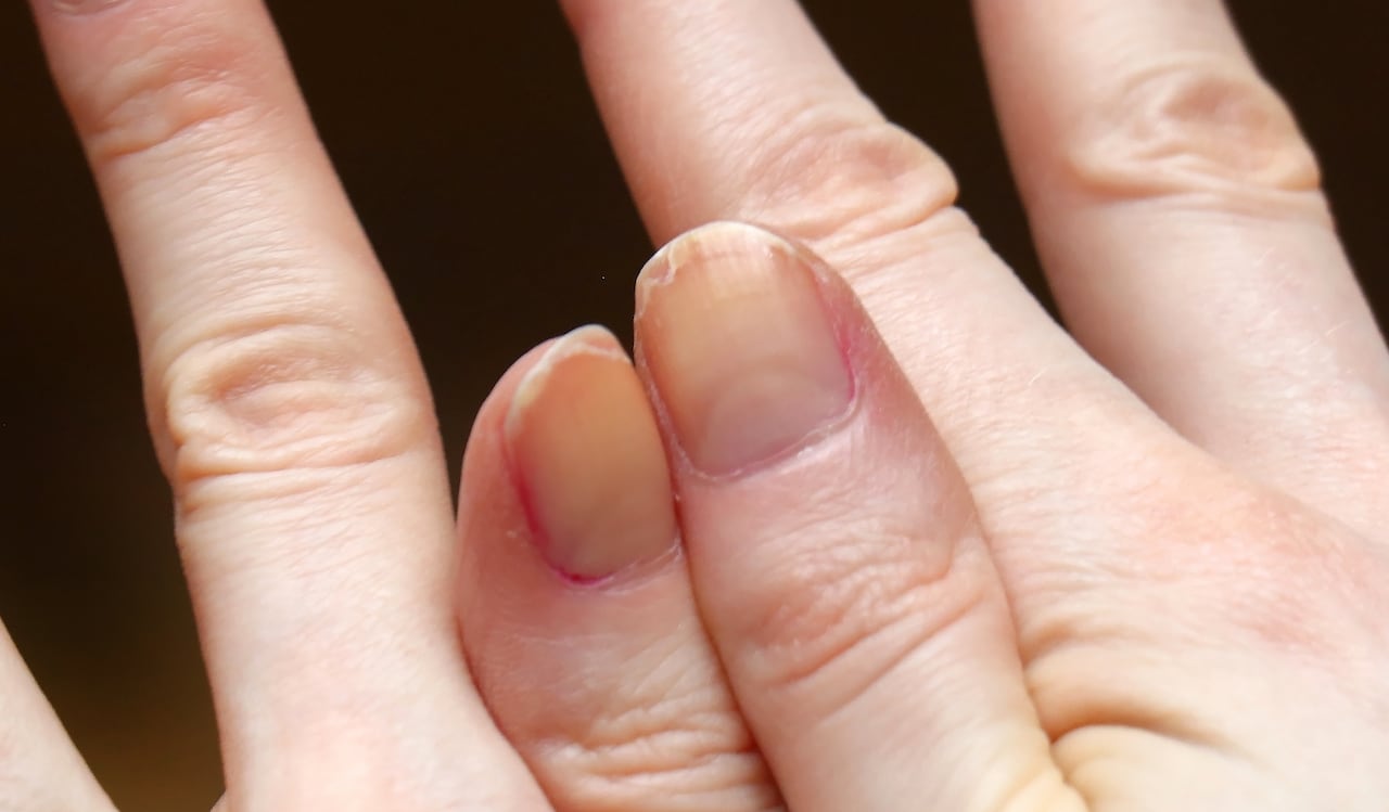 Uñas amarillentas