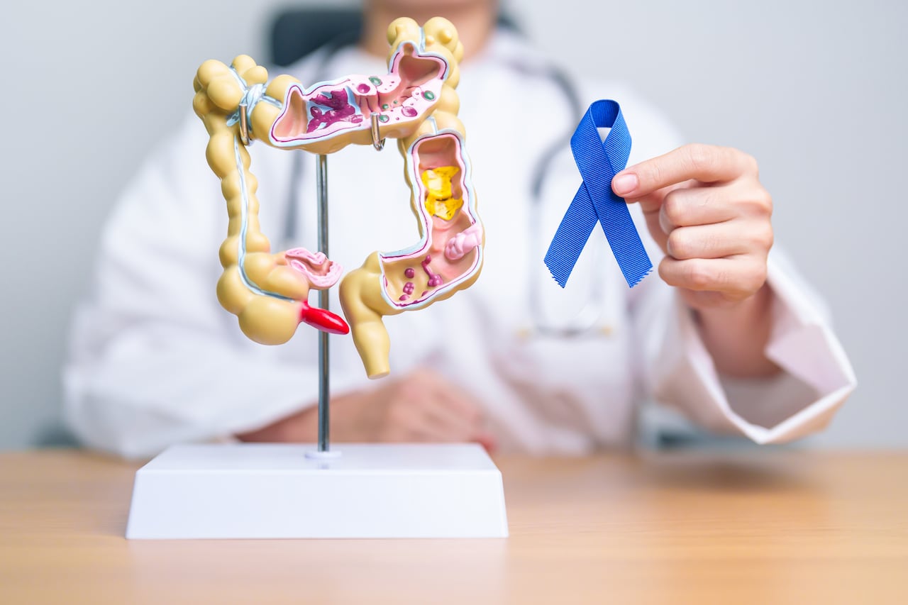 Cáncer de colon