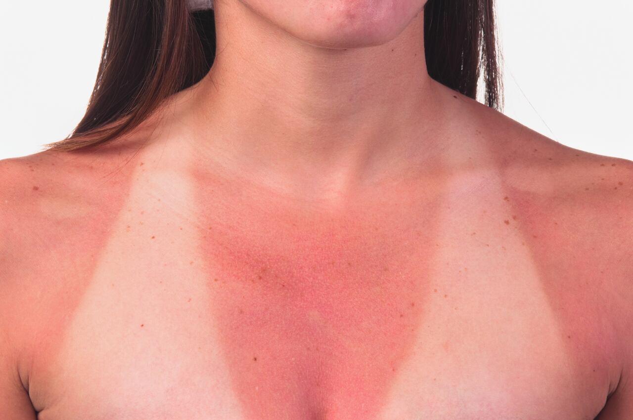 Foto de referencia sobre piel quemada
