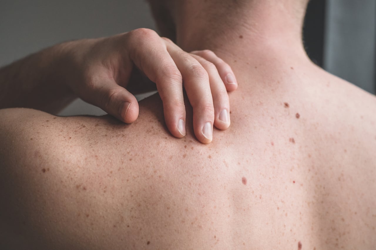 Melanoma