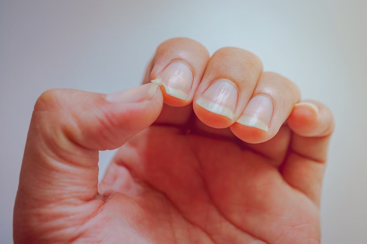 Uñas quebradizas