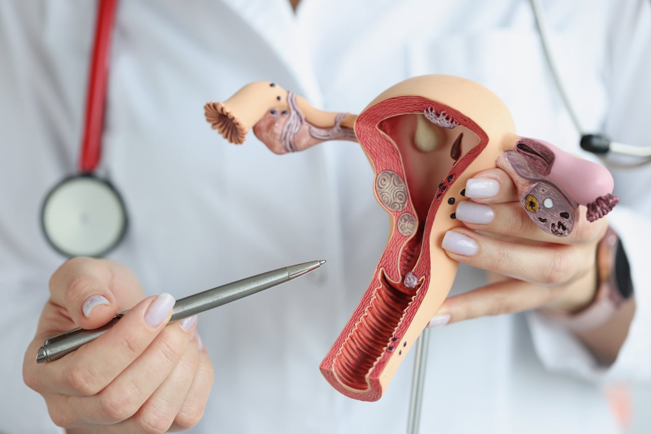 Cáncer de cuello uterino