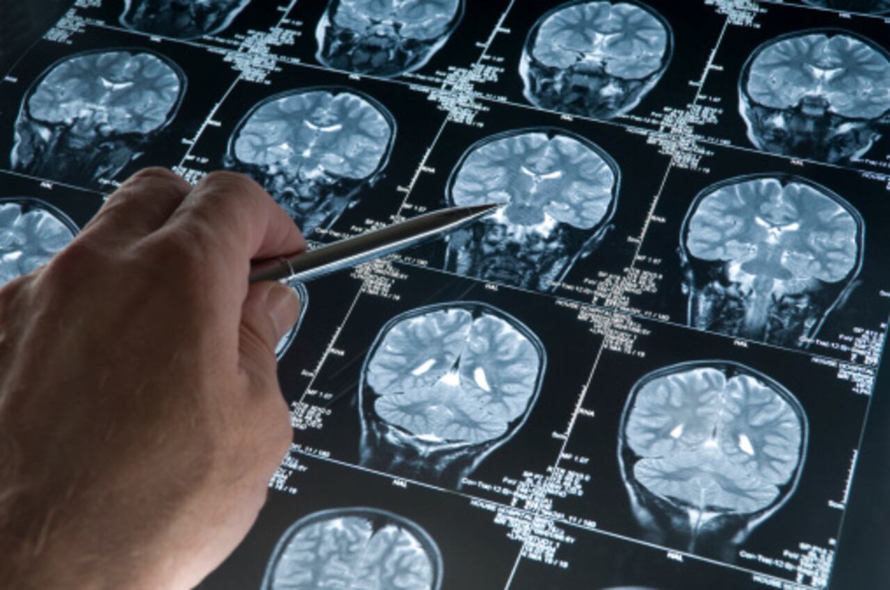 Tumores cerebrales.
