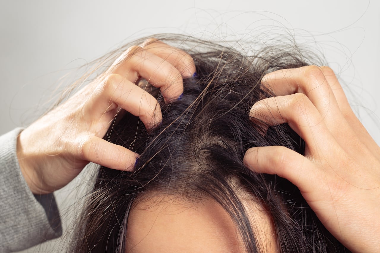 En algunos casos, la caspa puede provocar piquiña e irritación.