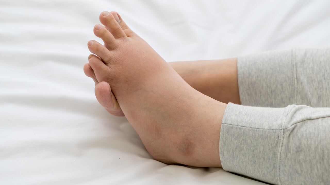 retención de líquidos. Pies hinchados